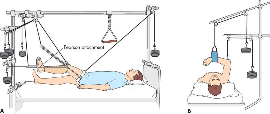 découvrez la station de traction, une installation essentielle pour les exercices de renforcement musculaire et de rééducation, alliant efficacité et sécurité.