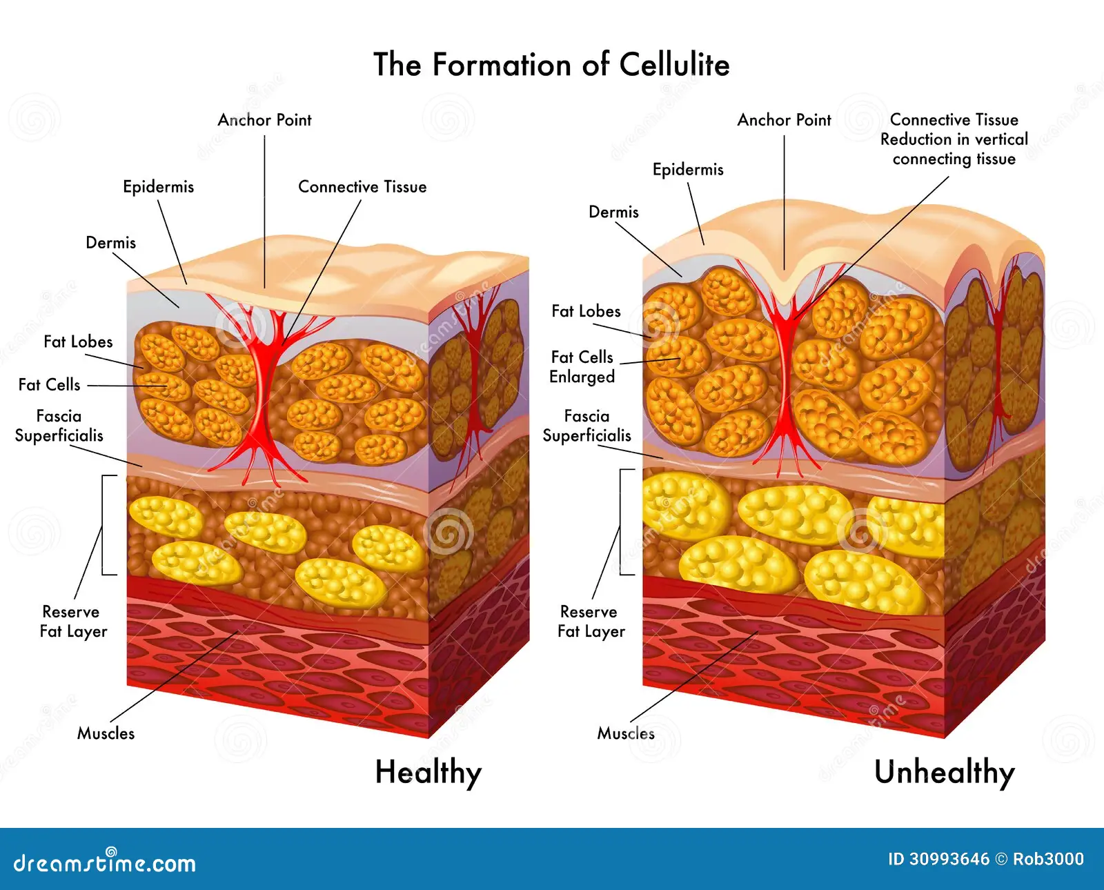 découvrez tout ce qu'il faut savoir sur la cellulite : causes, traitements efficaces et conseils pour la réduire naturellement.
